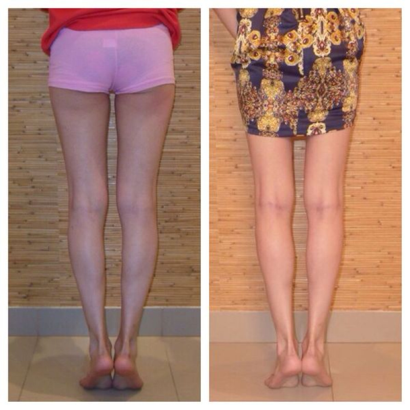Круропластика ног. Ровные ноги. Кривые ноги у девушек. Кривые и ровные ноги.